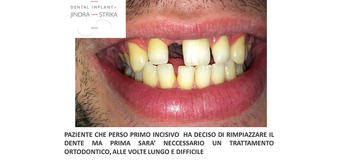 PERCHÉ É IMPORTANTE SOSTITUIRE I DENTI MANCANTI